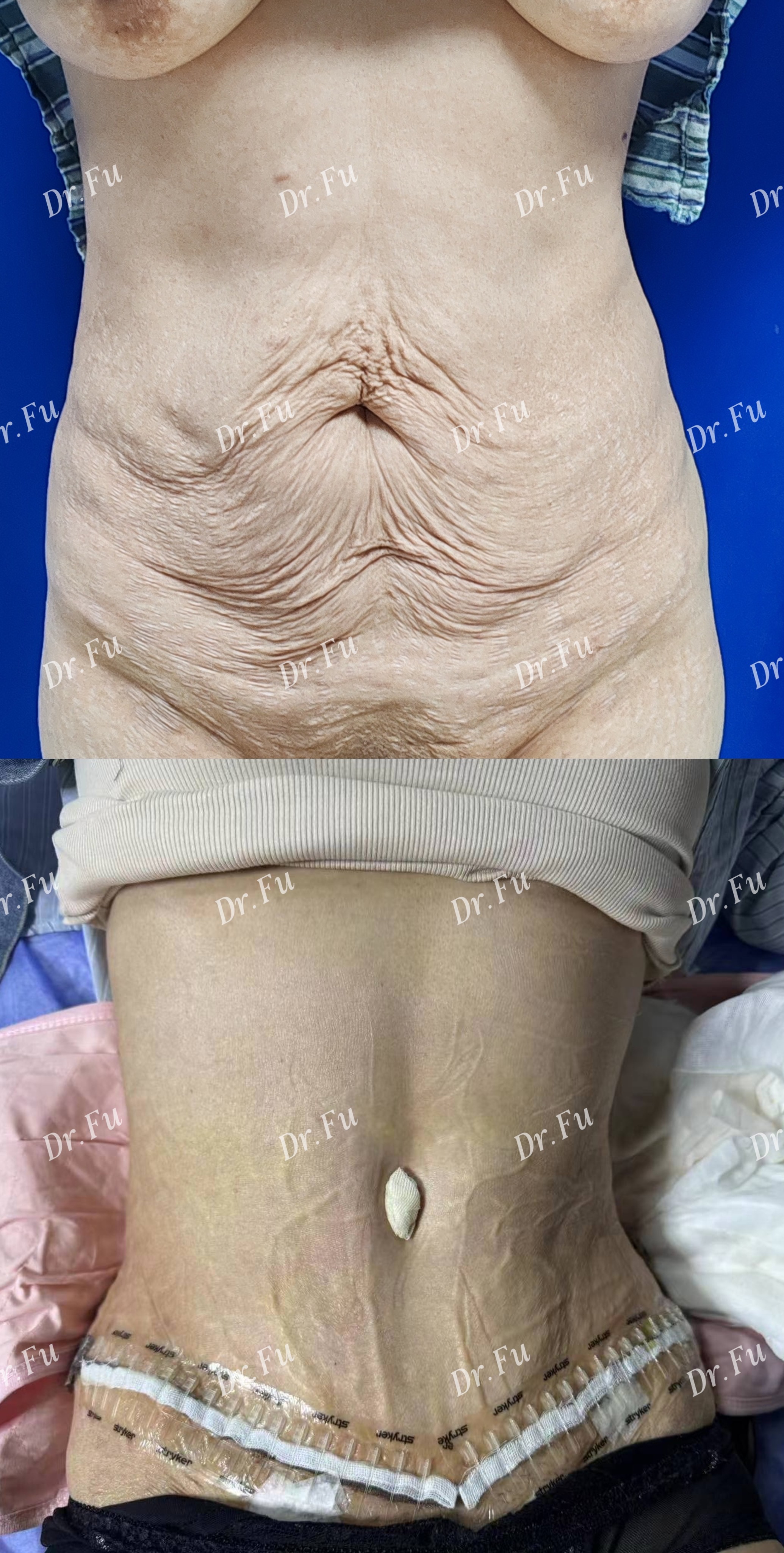 Abdominoplasty Case 4